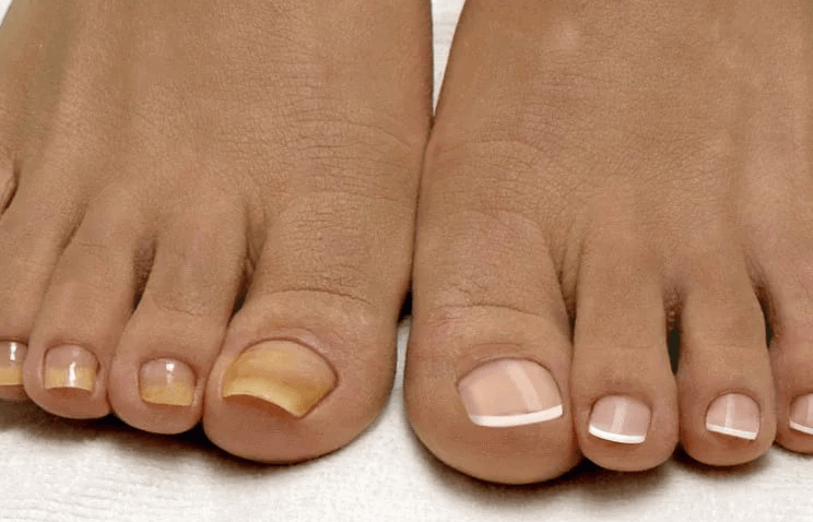 Лечение грибка ногтей и стопы