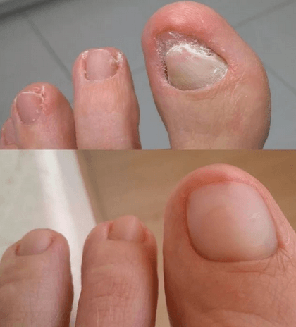 Лечение вросшего ногтя титановой нитью