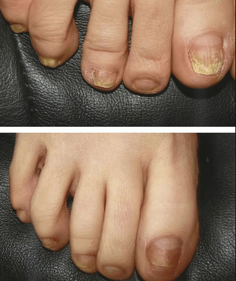 Лечение вросшего ногтя титановой нитью