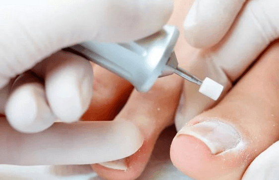 Лечение вросшего ногтя жестким протезированием