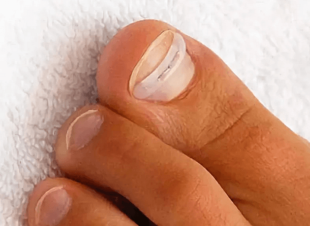 Лечение вросшего ногтя мягким протезированием
