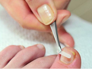 Лечение вросшего ногтя мягким протезированием